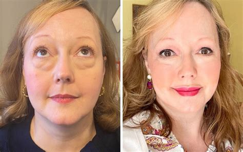 fake bags under eyes|under eye bag treatment dermatologist.